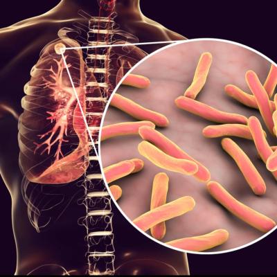 මෙරට 45%ක් ක්ෂය රෝගීන් බස්නාහිර පළාතෙන් - අවදානම් ස්ථාන එලියට